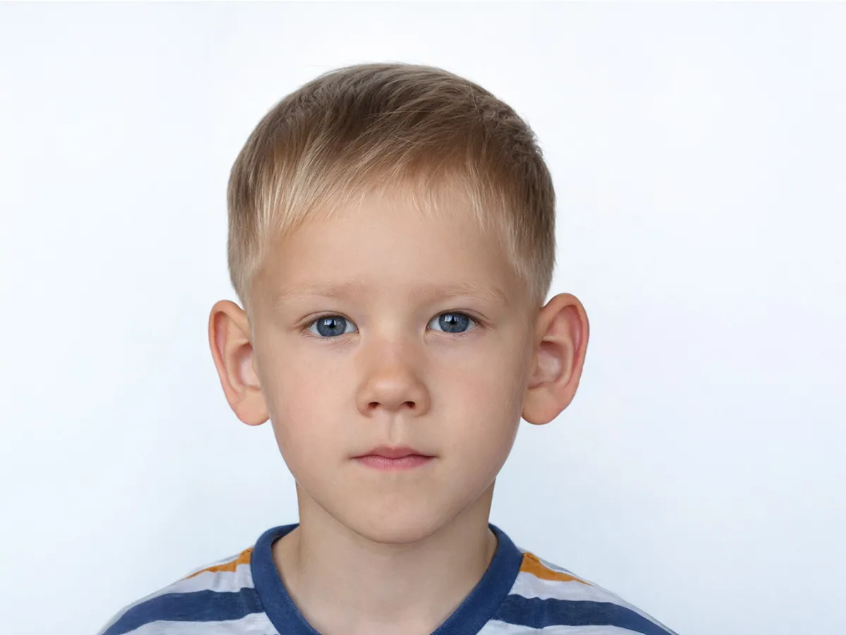 Kepçe Kulak (Kulak Estetiği - Otoplasti)